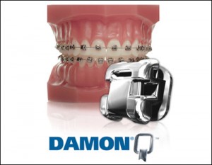 damon-braces.jpg